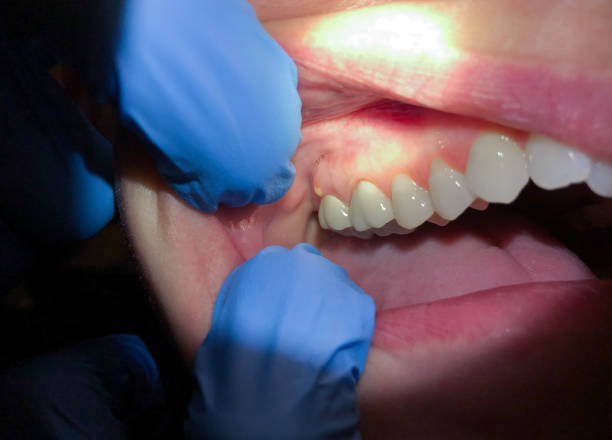 Best Emergency Treatment for Oral Infections in Weaverville, NC